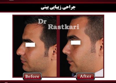 قبل و بعد عمل بینی مردان