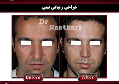 قبل و بعد جراحی بینی مردانه