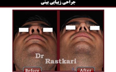 بیهوشی در عمل بینی چگونه است و چه اثراتی روی بیمار دارد؟