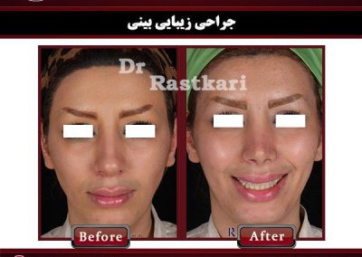 نمونه قبل و بعد جراحی بینی