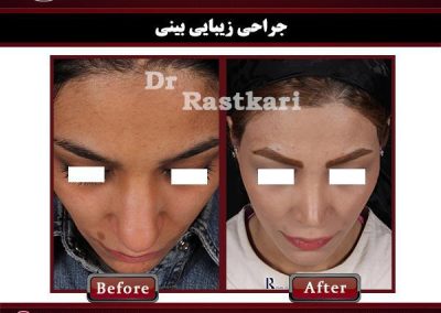 یک نمونه جراحی بینی در خانم ها