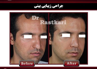 جراحی زیبایی بینی مردانه