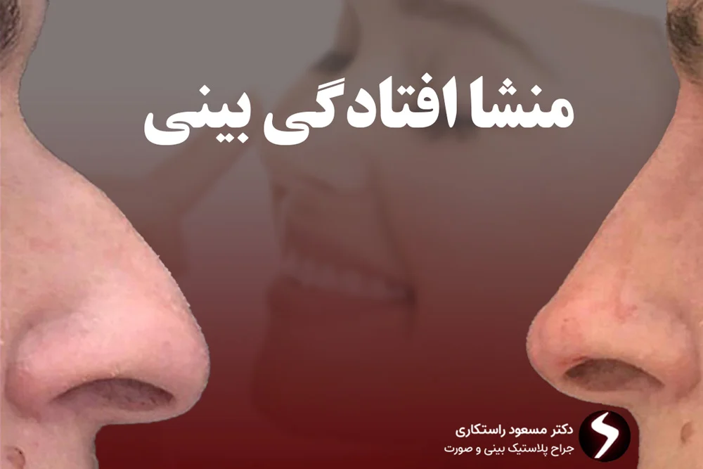 دلیل افتادگی بینی