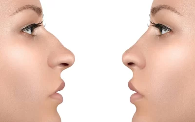 عمل بینی کج: مزایا و زمان مناسب جراحی + معرفی بهترین جراح