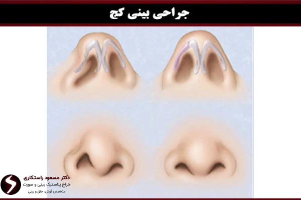 جراحی بینی کج چیست