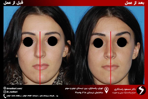 نمونه جراحی بینی کج