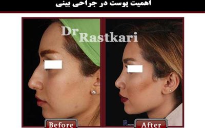 اهمیت پوست در جراحی بینی