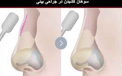 سوهان کشیدن بینی