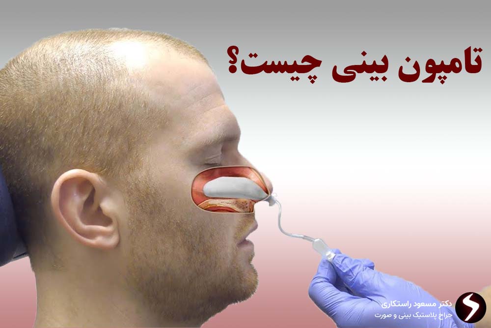 تامپون بینی چیست تامپون بینی چیست