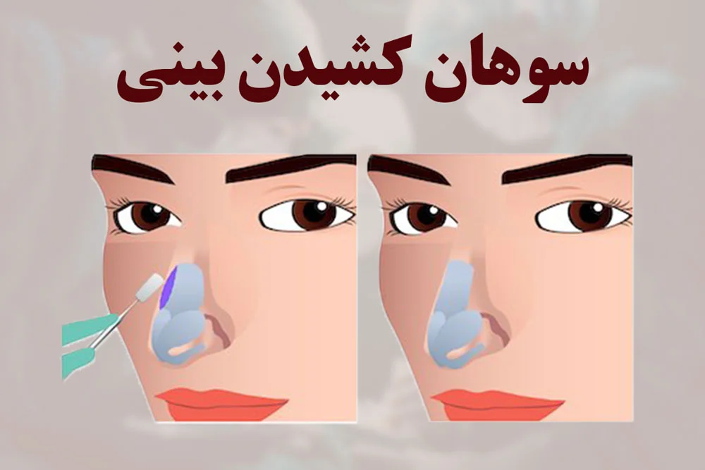 رسپینگ بینی