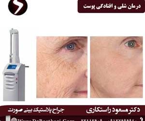 درمان شلی و افتادگی پوست