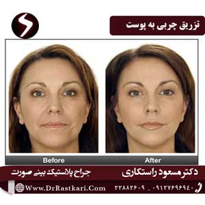 تزریق کردن چربی به پوست