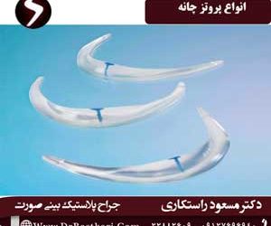 انواع پروتز چانه