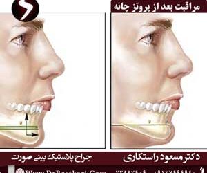 مراقبت های بعد از پروتز چانه