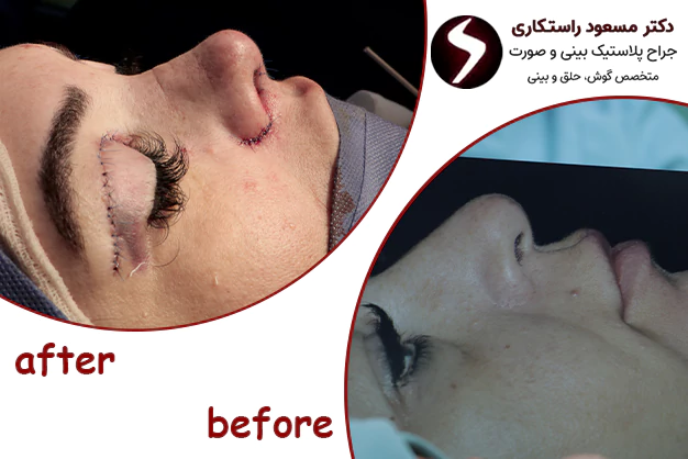 کاندیدای مناسب عمل بینی بدون بیهوشی