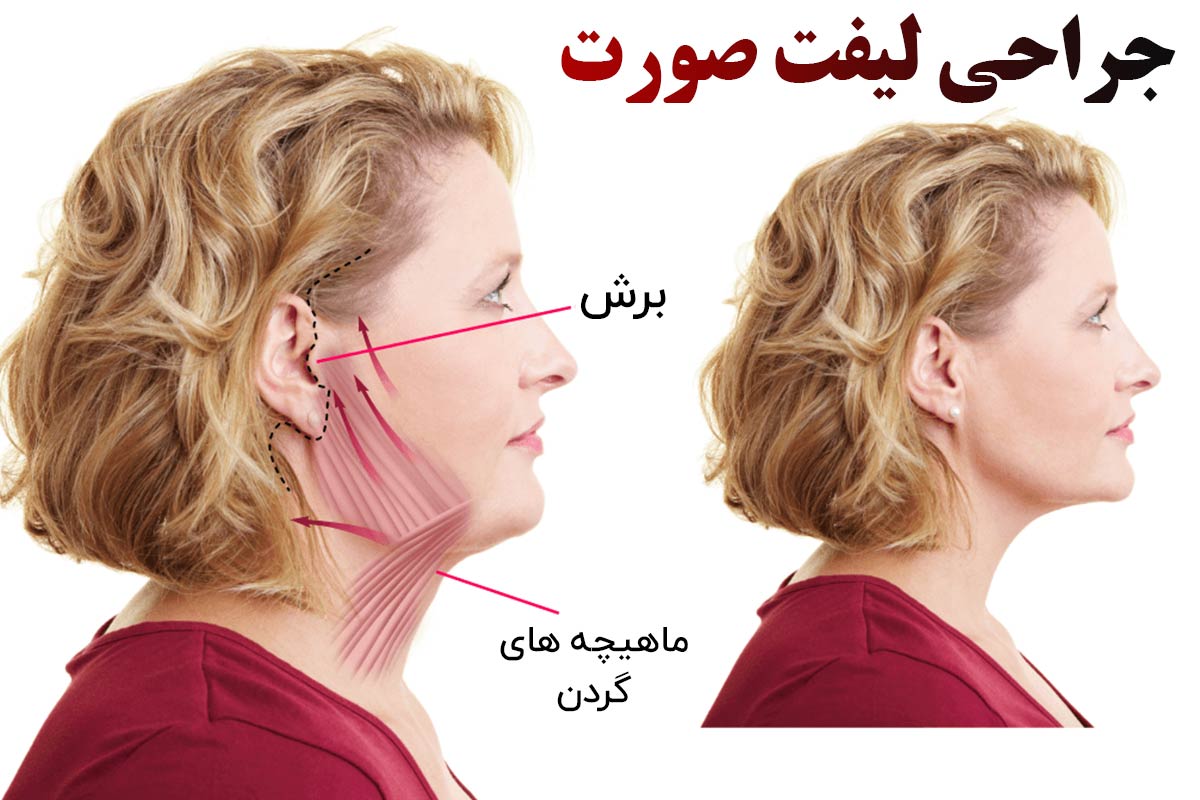 جراحی لیفت صورت