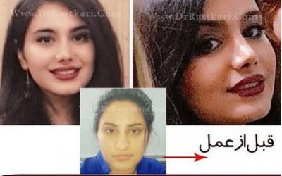 الرياضة و جراحة الأنف