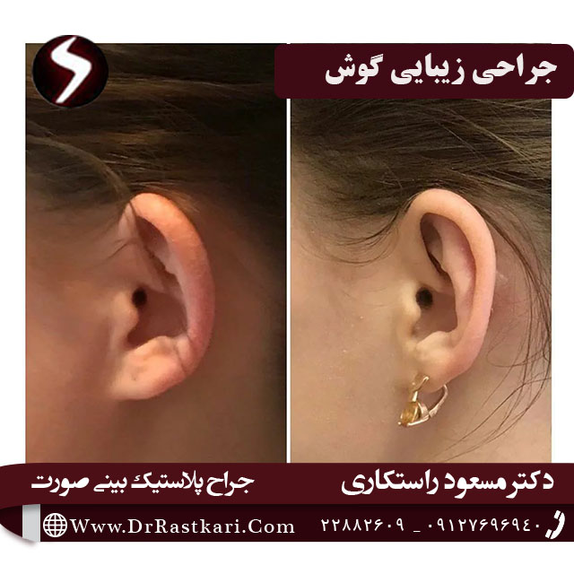 جراحی-زیبایی-گوش
