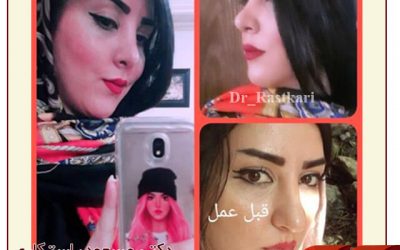 حقن الهلام تحت العينين