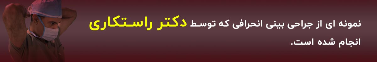 نمونه کار جراحی انحراف بینی نمونه کار جراحی انحراف بینی