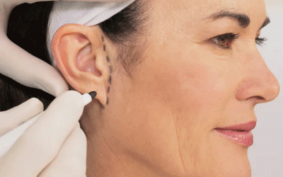 جراحه تجمیلیه الاذن