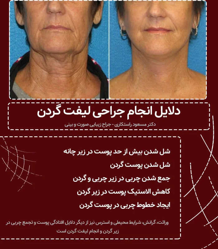 دلایل جراحی لیفت گردن