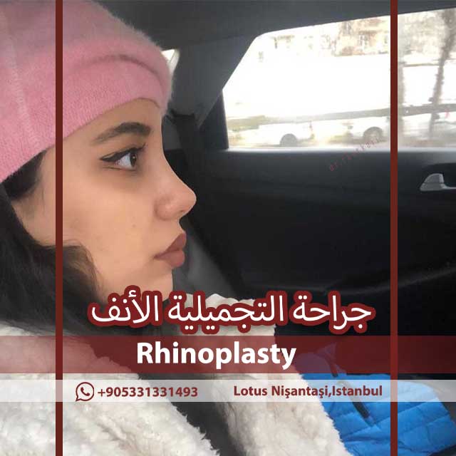 تورم وكدمات بعد جراحة الأنف