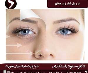 تزریق فیلر زیر چشم، روشی برای رفع تیرگی ها