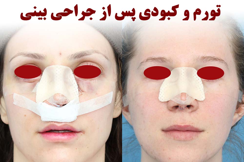 کبودی پس از جراحی بینی
