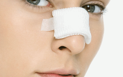 تورم وكدمات بعد جراحة الأنف