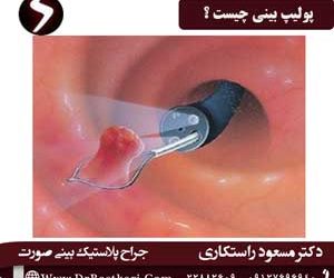 پولیپ بینی: علائم، دلایل و روش‌های پیشگیری و بهترین درمان