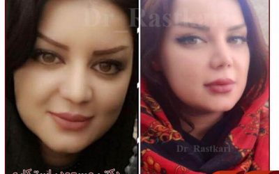 حقن البوتوکس