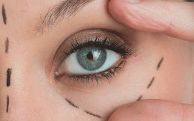 جراحه الجفن العلیا