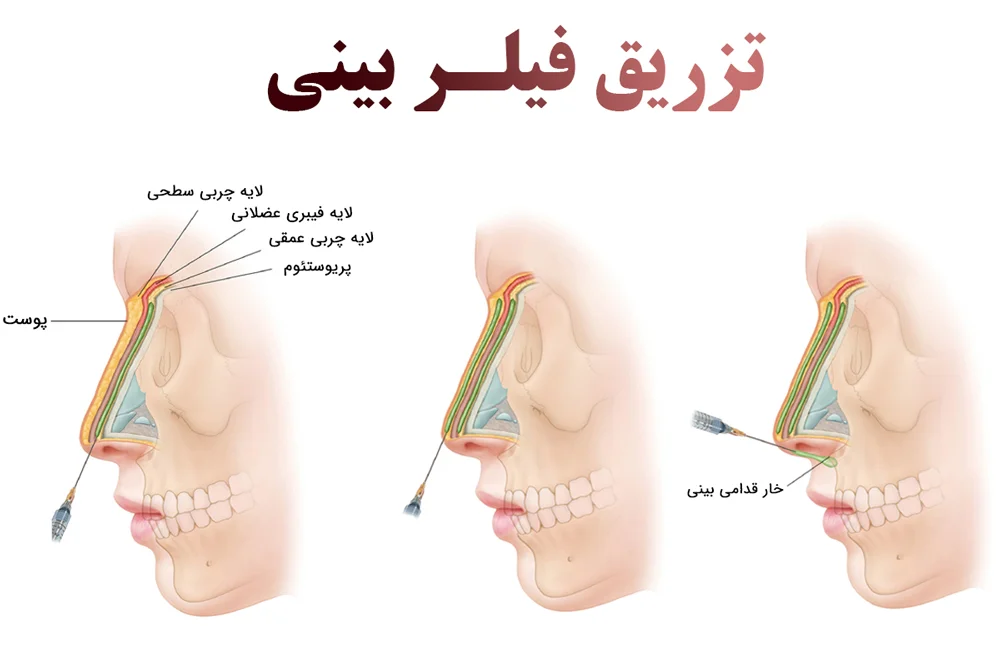 تزریق ژل بینی تزریق ژل بینی