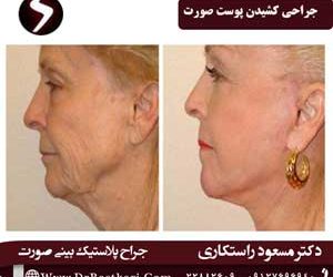 جراحی کشیدن پوست صورت