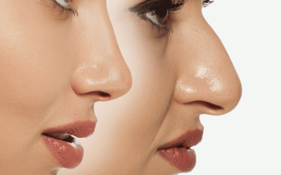 ما هي أفضل طريقة جراحة الأنف؟