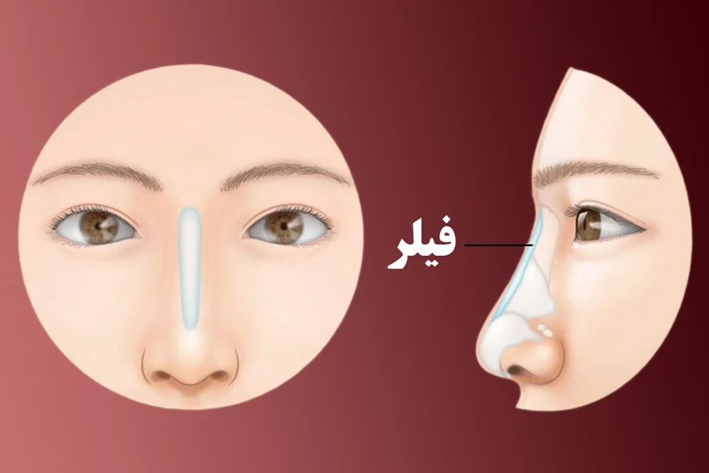 تزریق فیلر بینی تزریق فیلر بینی
