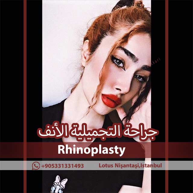 حقن هلام الشفة    