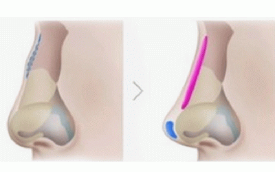 جراحة الأنف والحساسية