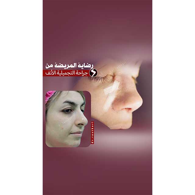 حقن الهلام تحت العينين  