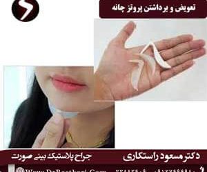 تعویض و برداشتن پروتز چانه