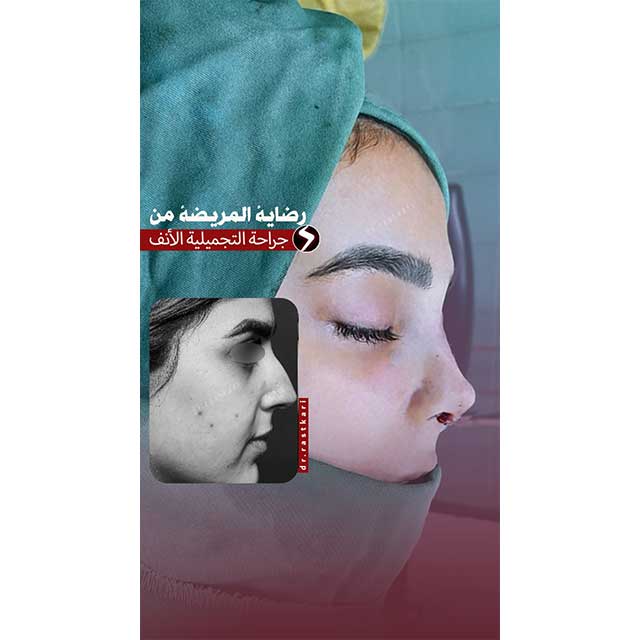 جراحة الأنف عند المراهقين          