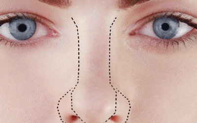 تدلي الأنف بعد جراحة الأنف