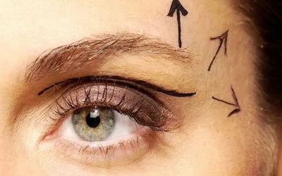 بهترین جراح بلفاروپلاستی در تهران با نمونه کارهای موفق و بالاترین رضایت