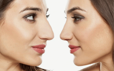 عملیة تجمیل الانف بافضل النتایج