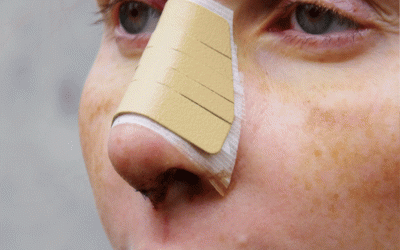 جراحة الأنف الفانتیسیة