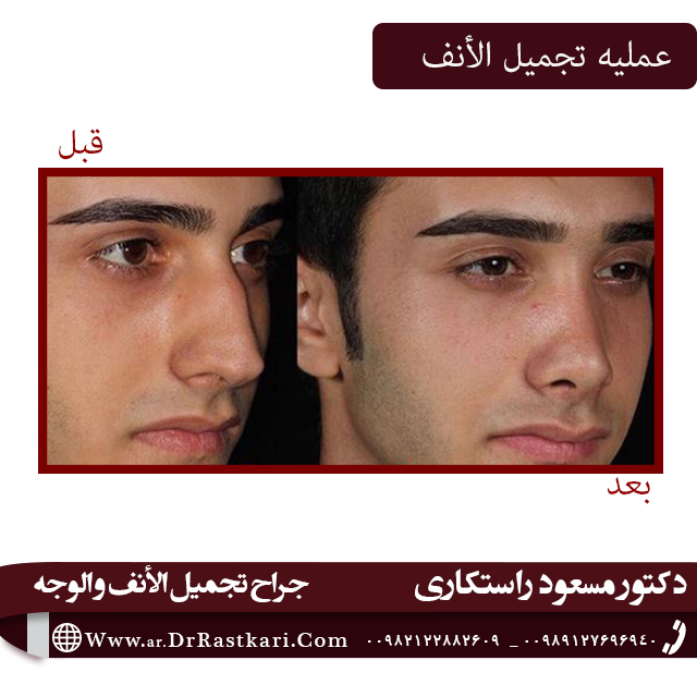 الرضا عن عملية تجميل الأنف الطبيعية