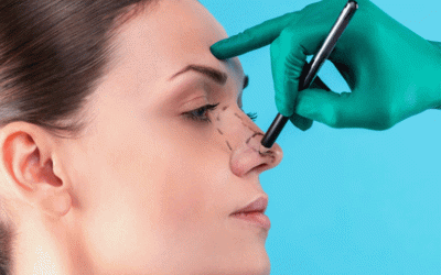 تجميل الأنف الثانویة