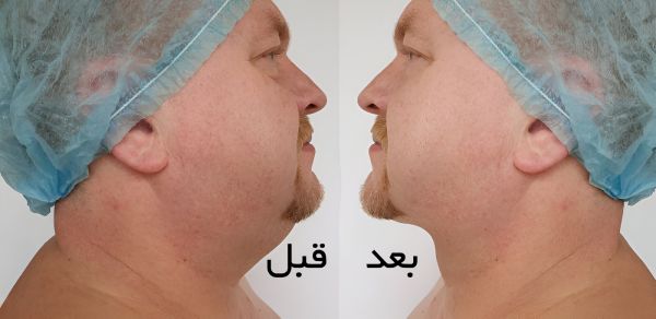 نتیجه عمل ساکشن غبغب برای آقایان