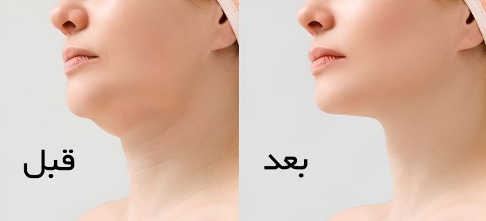 قبل و بعد از ساکشن غبغب برای خانم ها